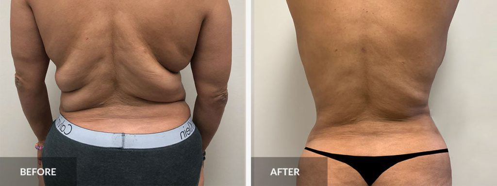 Hidden costs of liposuction long-term maintenance