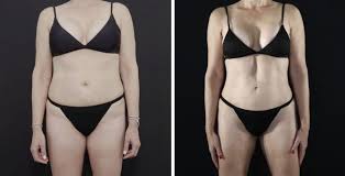 VASER Liposuction: Advanced Body Contouring Technology