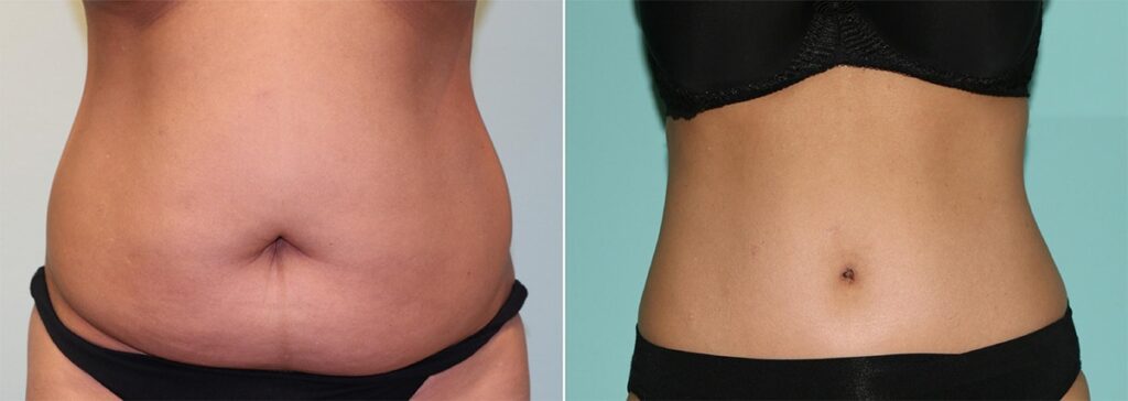 Swelling management after body contouring surgery
