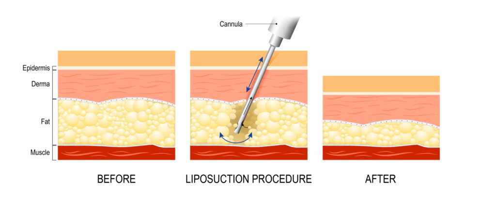 VASER liposuction technology diagram